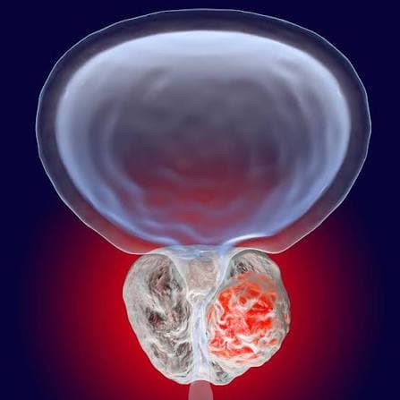 Genitourinary - Radiation Oncology Care by Dr. Sarthak Kumar Mohanty in Rajkot, Gujarat